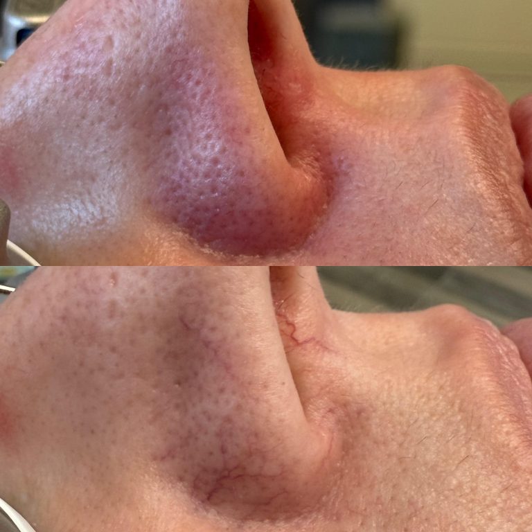 nose-veins-face-boutique